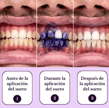 Sonrisa Radiante en 15 Segundos - Espuma Blanqueadora V34 - CHILECLIKK